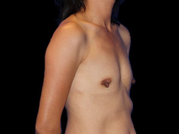 Breast Augmentation Before & After Gallery - Patient 13574615 - Image 3
