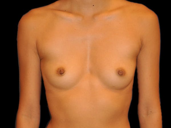 Breast Augmentation Before & After Gallery - Patient 13574617 - Image 1
