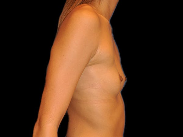 Breast Augmentation Before & After Gallery - Patient 13574617 - Image 5
