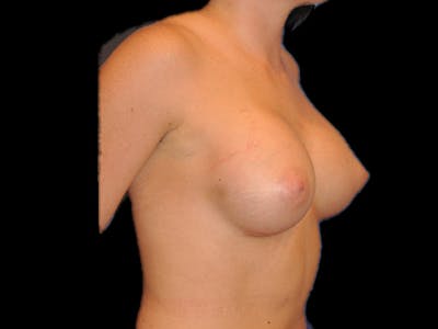 Breast Augmentation Before & After Gallery - Patient 13574580 - Image 4