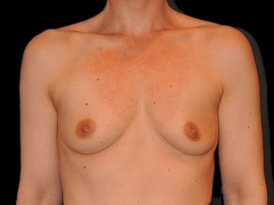 Breast Augmentation Before & After Gallery - Patient 13574613 - Image 1
