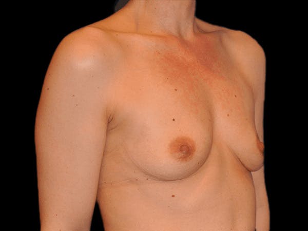 Breast Augmentation Before & After Gallery - Patient 13574613 - Image 3