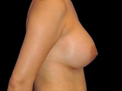 Breast Augmentation Before & After Gallery - Patient 13574643 - Image 6