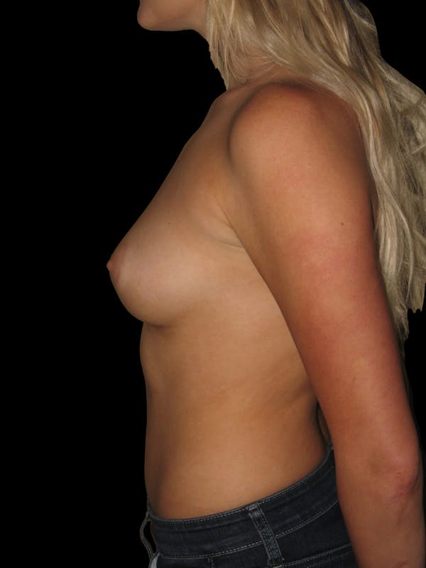 Breast Augmentation Before & After Gallery - Patient 13574596 - Image 5