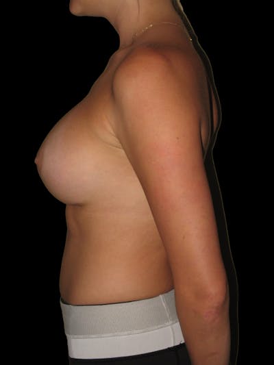 Breast Augmentation Before & After Gallery - Patient 13574596 - Image 6