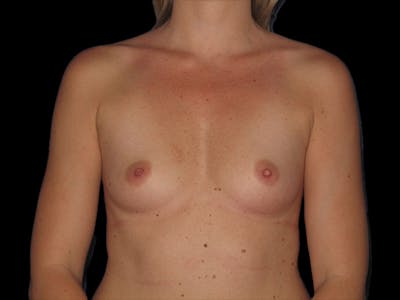 Breast Augmentation Before & After Gallery - Patient 13574600 - Image 1