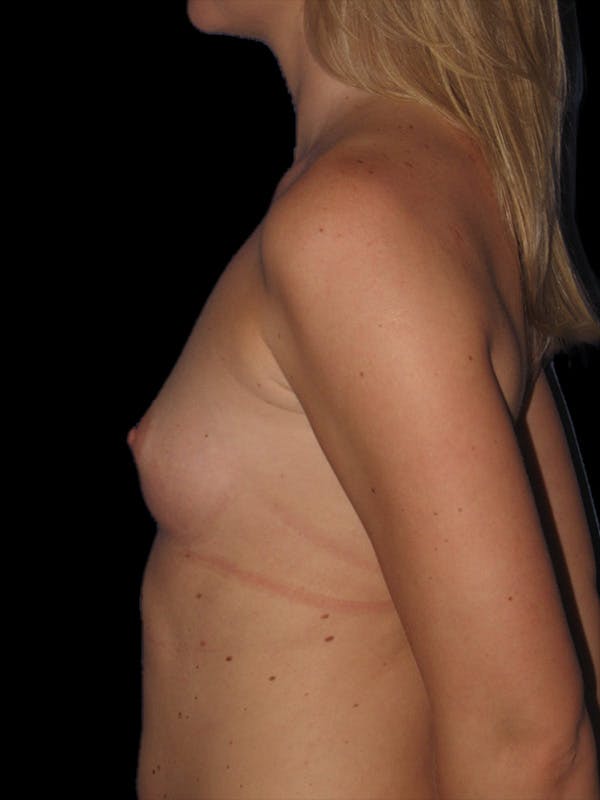 Breast Augmentation Before & After Gallery - Patient 13574600 - Image 5