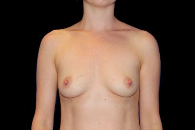 Breast Augmentation Before & After Gallery - Patient 13574576 - Image 1