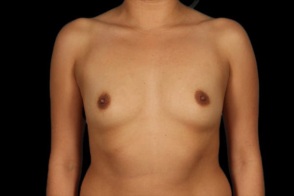 Breast Augmentation Before & After Gallery - Patient 13574591 - Image 1