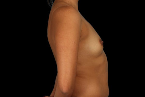 Breast Augmentation Before & After Gallery - Patient 13574591 - Image 5