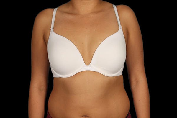 Breast Augmentation Before & After Gallery - Patient 13574591 - Image 7