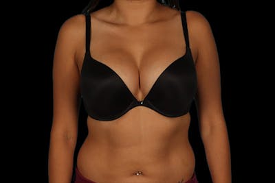 Breast Augmentation Before & After Gallery - Patient 13574591 - Image 8