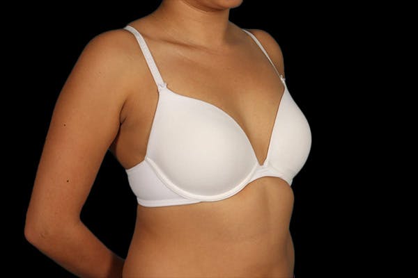 Breast Augmentation Before & After Gallery - Patient 13574591 - Image 9