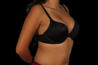 Breast Augmentation Before & After Gallery - Patient 13574591 - Image 10