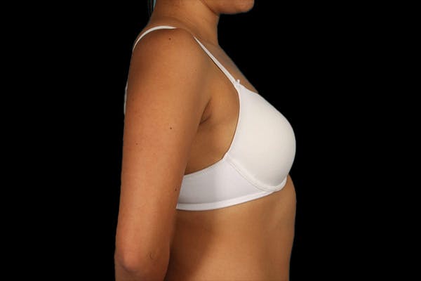 Breast Augmentation Before & After Gallery - Patient 13574591 - Image 11
