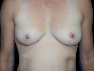 Breast Augmentation Before & After Gallery - Patient 13574566 - Image 1