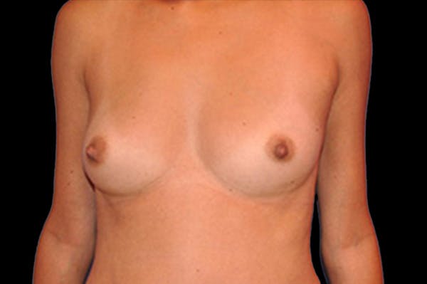 Breast Augmentation Before & After Gallery - Patient 13574629 - Image 1