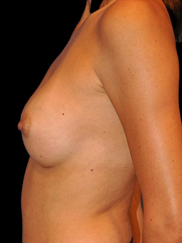 Breast Augmentation Before & After Gallery - Patient 13574629 - Image 4