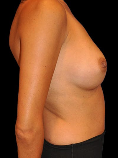 Breast Augmentation Before & After Gallery - Patient 13574629 - Image 6