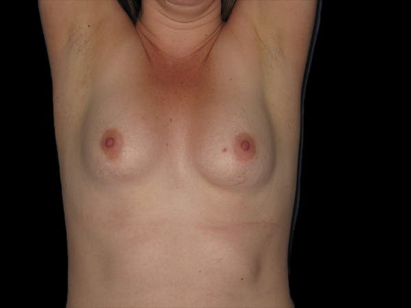 Breast Augmentation Before & After Gallery - Patient 13574610 - Image 1