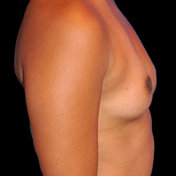 Breast Augmentation Before & After Gallery - Patient 13574631 - Image 3