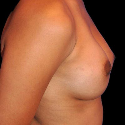 Breast Augmentation Before & After Gallery - Patient 13574631 - Image 4