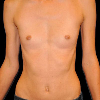 Breast Augmentation Before & After Gallery - Patient 13574632 - Image 1