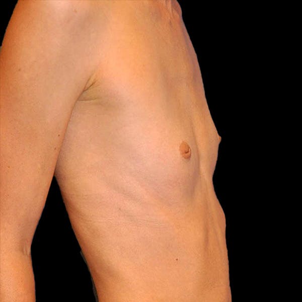 Breast Augmentation Before & After Gallery - Patient 13574632 - Image 3