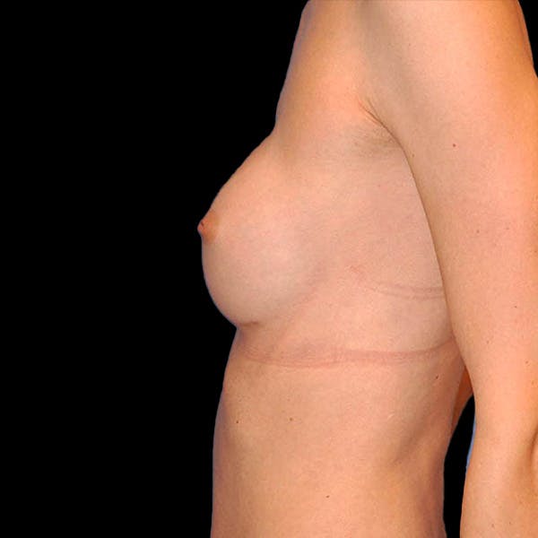 Breast Augmentation Before & After Gallery - Patient 13574632 - Image 8