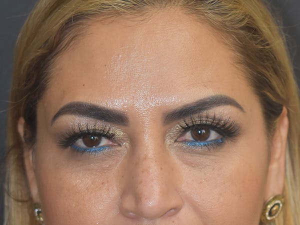 Botox Before & After Gallery - Patient 147721317 - Image 2