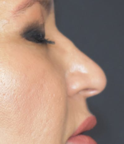 Liquid Rhinoplasty Before & After Gallery - Patient 147721320 - Image 1