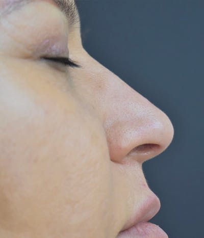 Liquid Rhinoplasty Before & After Gallery - Patient 147721320 - Image 2