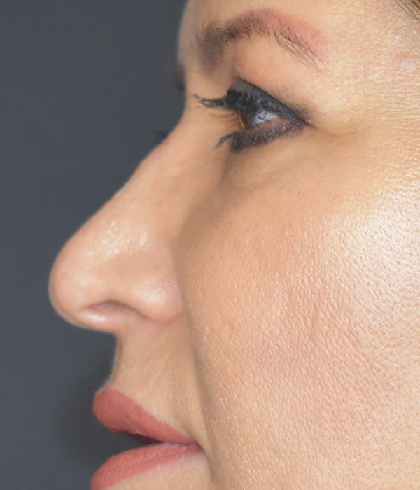 Liquid Rhinoplasty Before & After Gallery - Patient 147721320 - Image 3