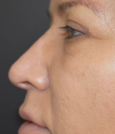 Liquid Rhinoplasty Before & After Gallery - Patient 147721320 - Image 4
