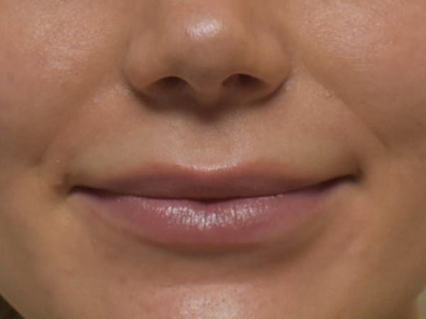 Lip Augmentation Before & After Gallery - Patient 147721324 - Image 1