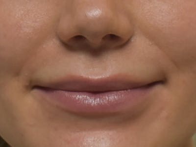 Lip Augmentation Before & After Gallery - Patient 147721324 - Image 1