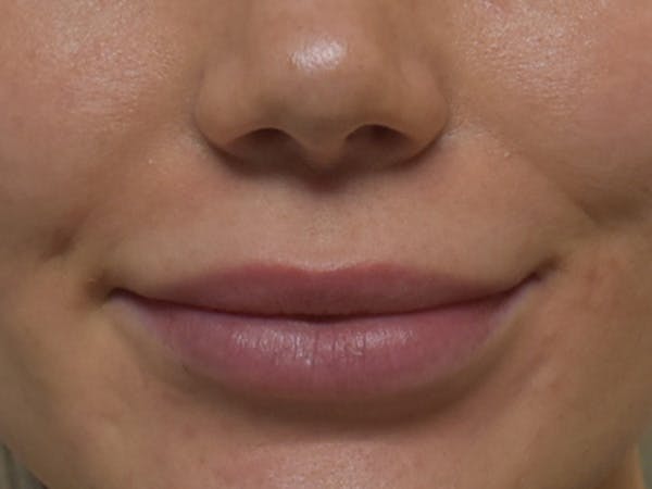 Lip Augmentation Before & After Gallery - Patient 147721324 - Image 2