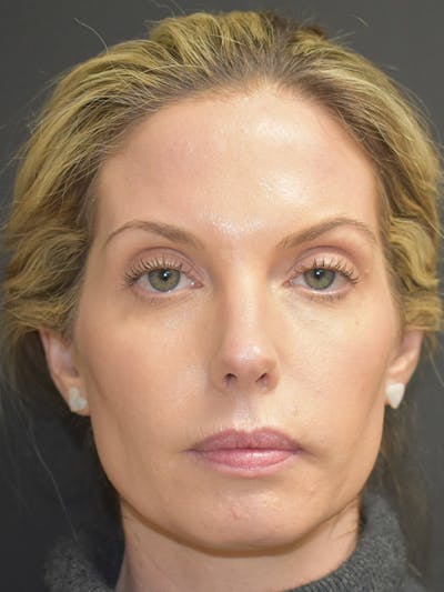 Liquid Facelift Before & After Gallery - Patient 147721330 - Image 1