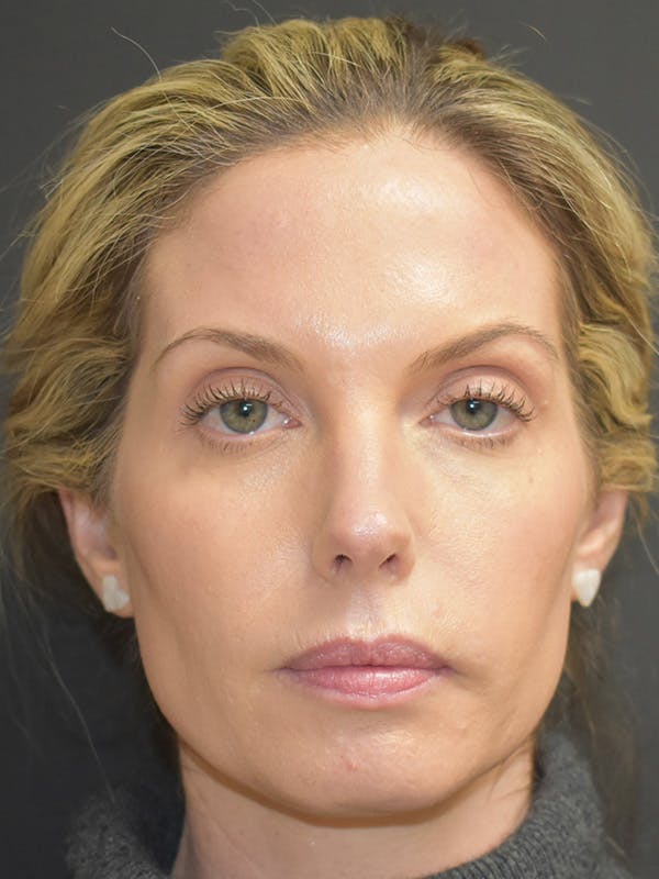 Liquid Facelift Before & After Gallery - Patient 147721330 - Image 1