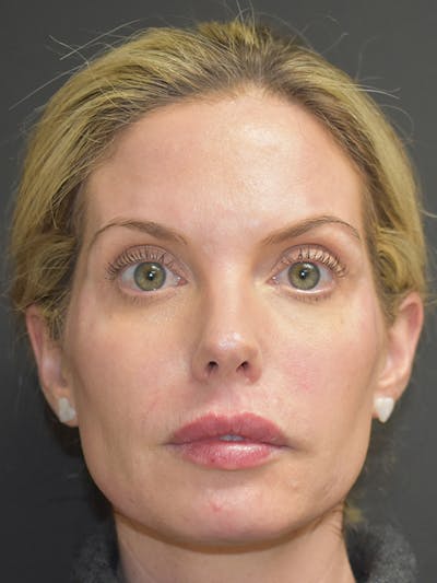 Liquid Facelift Before & After Gallery - Patient 147721330 - Image 2