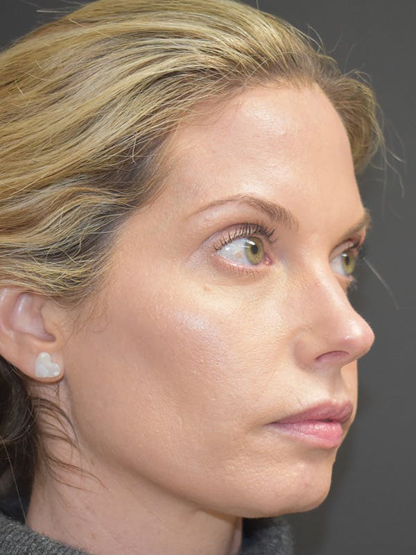 Liquid Facelift Before & After Gallery - Patient 147721330 - Image 3