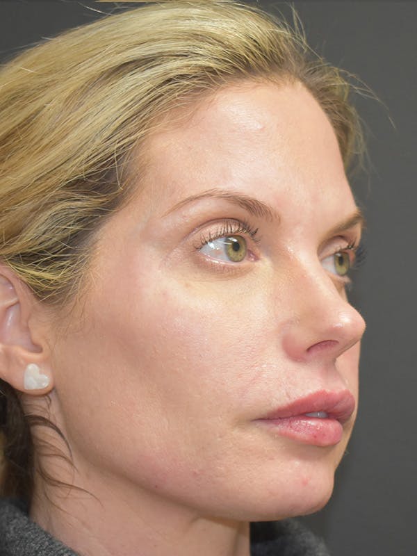 Liquid Facelift Before & After Gallery - Patient 147721330 - Image 4