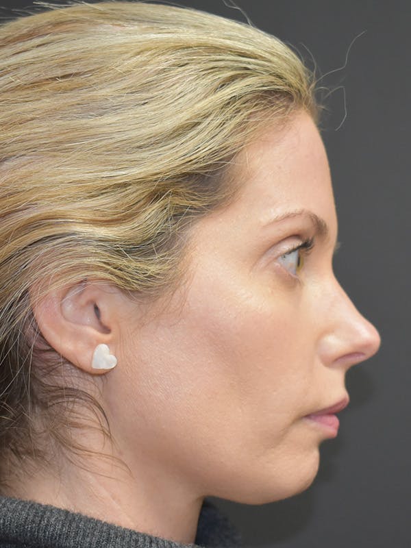 Liquid Facelift Before & After Gallery - Patient 147721330 - Image 5