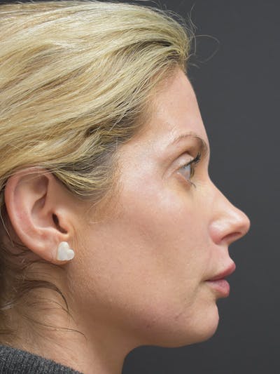 Liquid Facelift Before & After Gallery - Patient 147721330 - Image 6