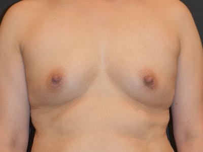 Breast Augmentation Before & After Gallery - Patient 147739964 - Image 1