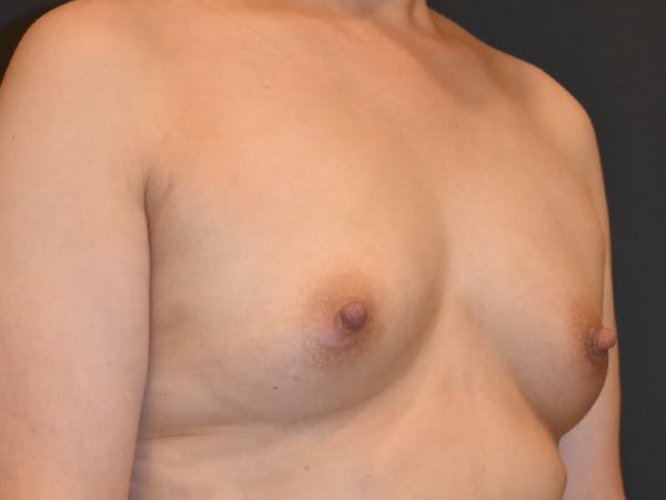 Breast Augmentation Before & After Gallery - Patient 147739964 - Image 3
