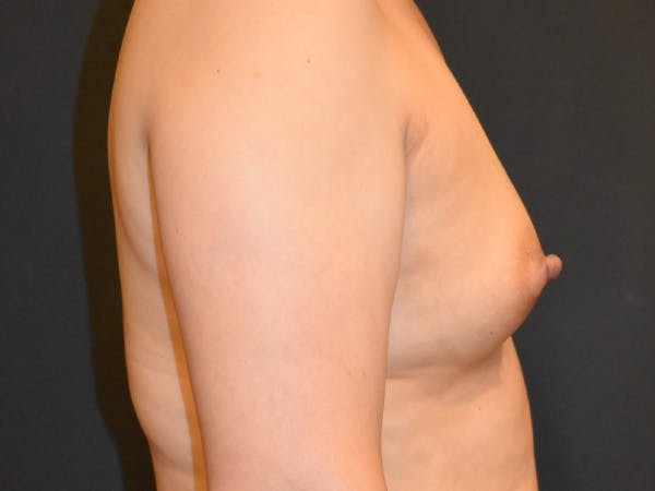 Breast Augmentation Before & After Gallery - Patient 147739964 - Image 5