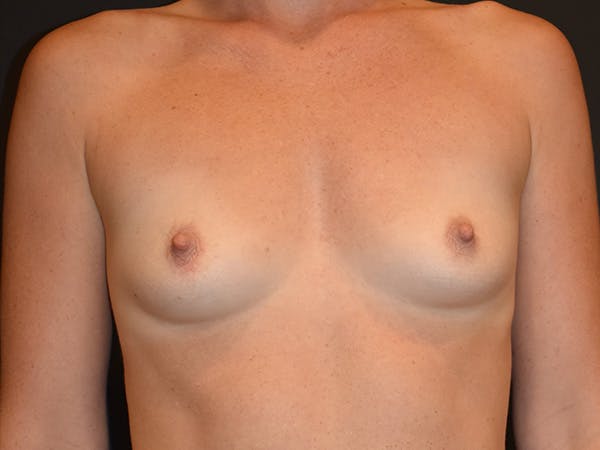 Breast Augmentation Before & After Gallery - Patient 147739963 - Image 1
