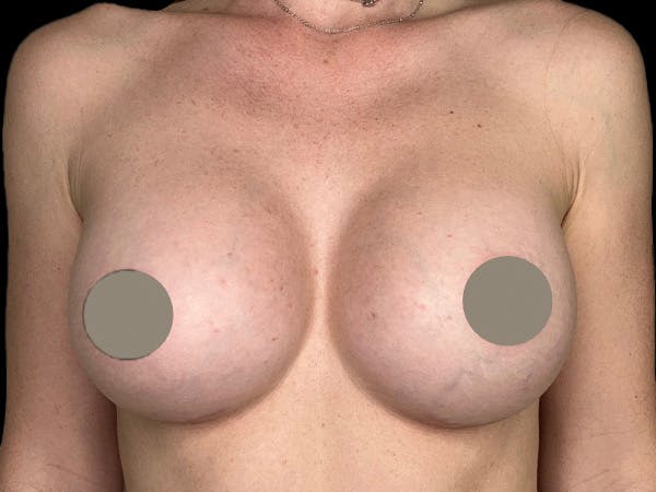 Breast Augmentation Before & After Gallery - Patient 147739963 - Image 2