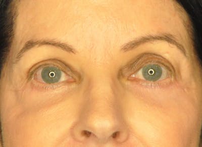 Blepharoplasty (Eyelid Surgery) Before & After Gallery - Patient 102776 - Image 1